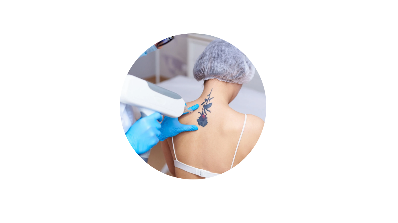Tattoo Removal